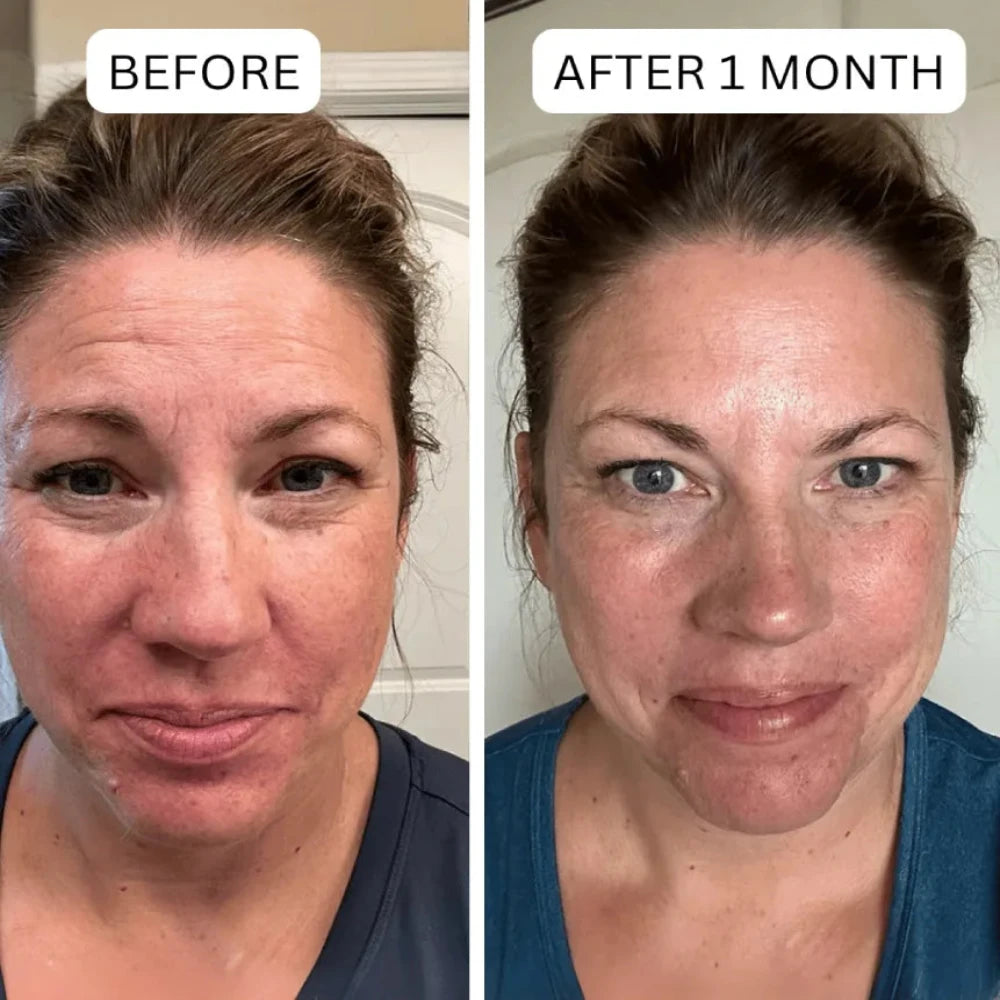 Before and after comparison of a woman's face with text labels 'Before' and 'After 1 Month'.